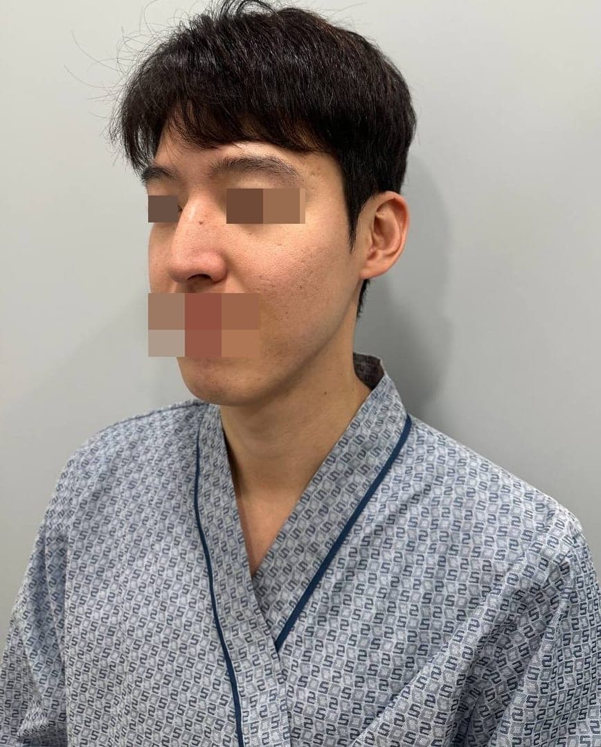 Tip plasty with own cartilage + osteotomy