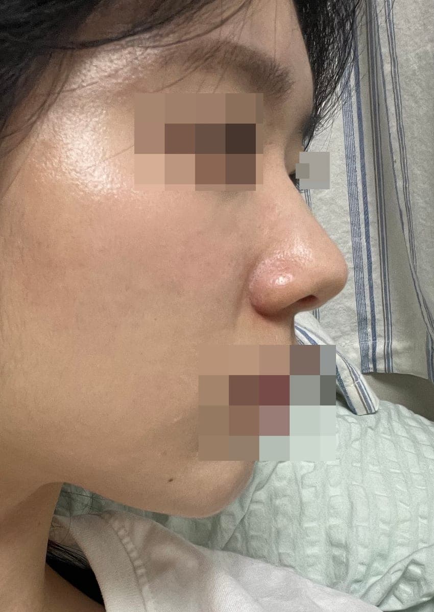 Bulbous tip correction, tip with donor cartilage + osteotomy