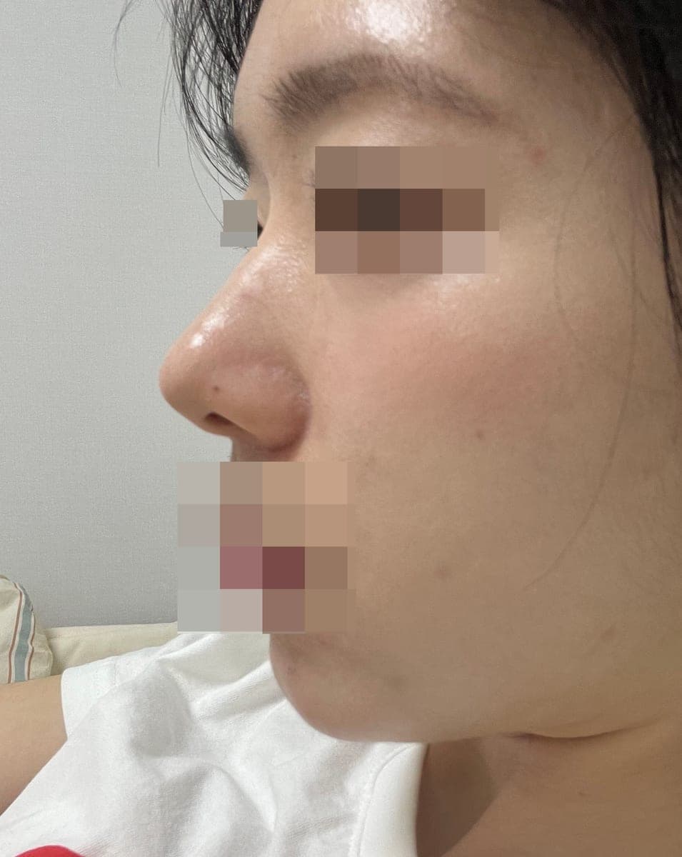 Bulbous tip correction, tip with donor cartilage + osteotomy