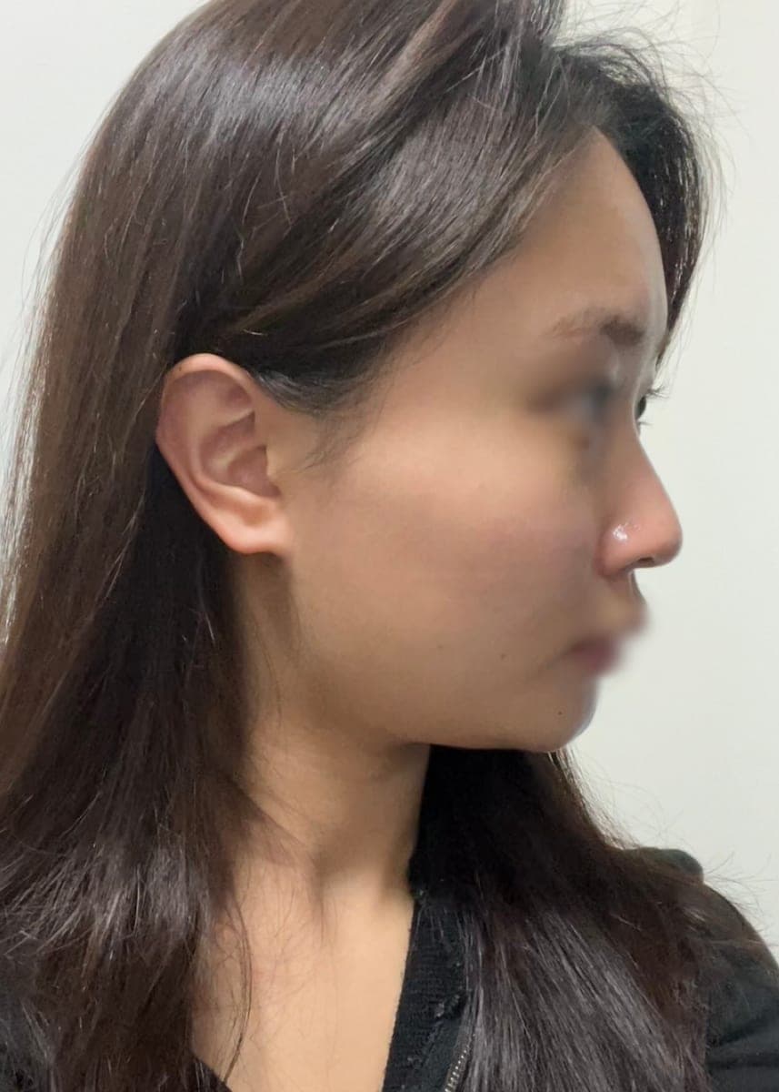 Bulbous tip correction, tip with donor cartilage + osteotomy