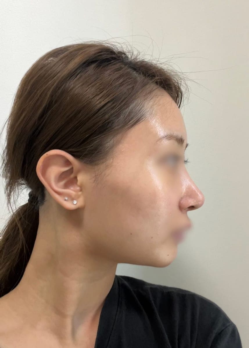 Bulbous tip correction, tip with donor cartilage + osteotomy