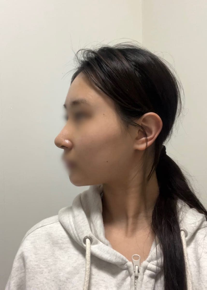 Bulbous tip correction, tip with donor cartilage + osteotomy