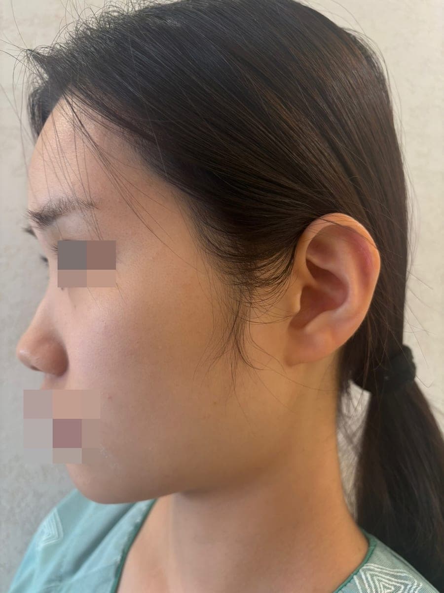 Koreksi hidung bengkok, ujung dengan tulang rawan donor