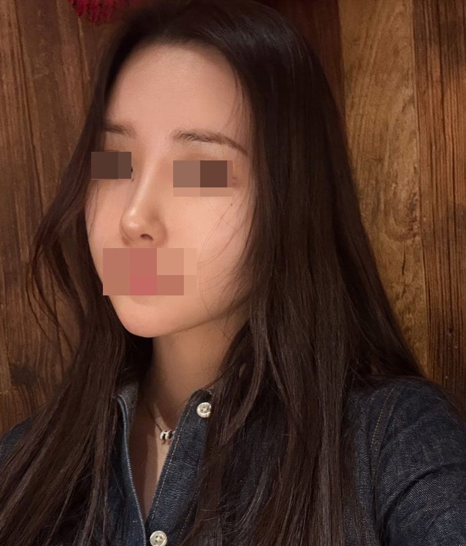 Koreksi hidung bengkok, ujung dengan tulang rawan donor