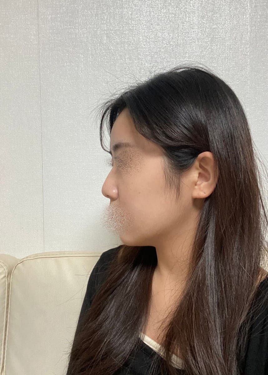A straighter bridge line, tip with own cartilage + osteotomy