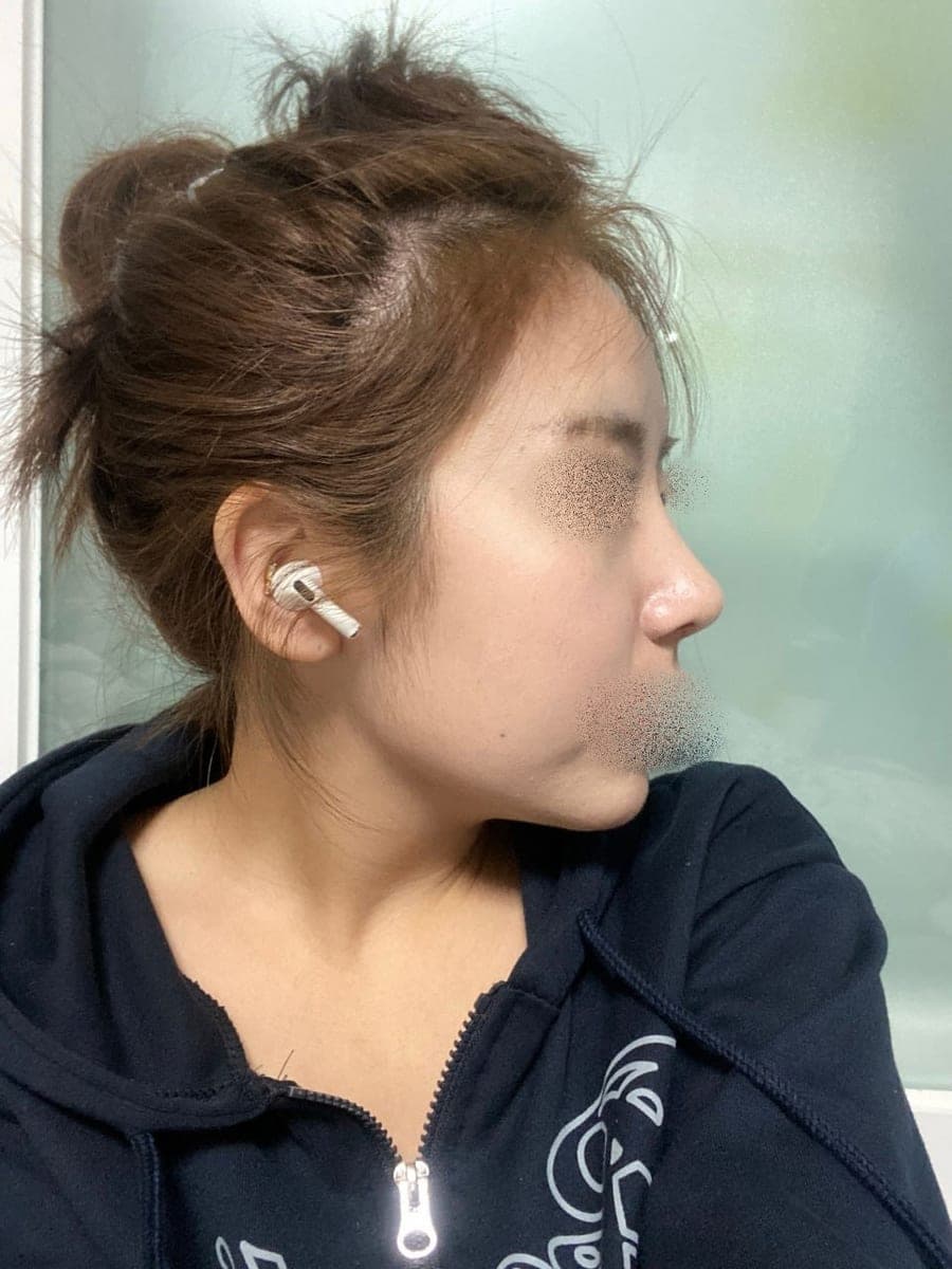 A straighter bridge line, tip with own cartilage + osteotomy