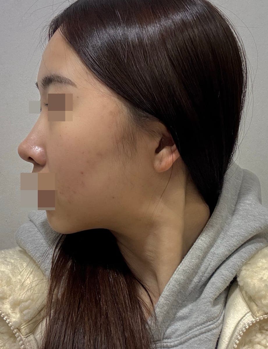 Tip only, with own cartilage
