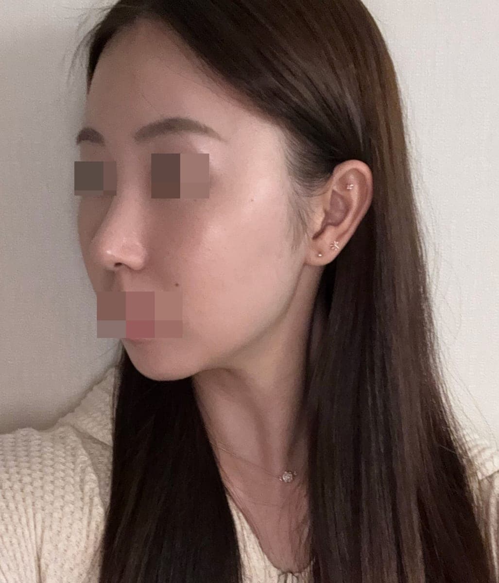 Tip only, with own cartilage
