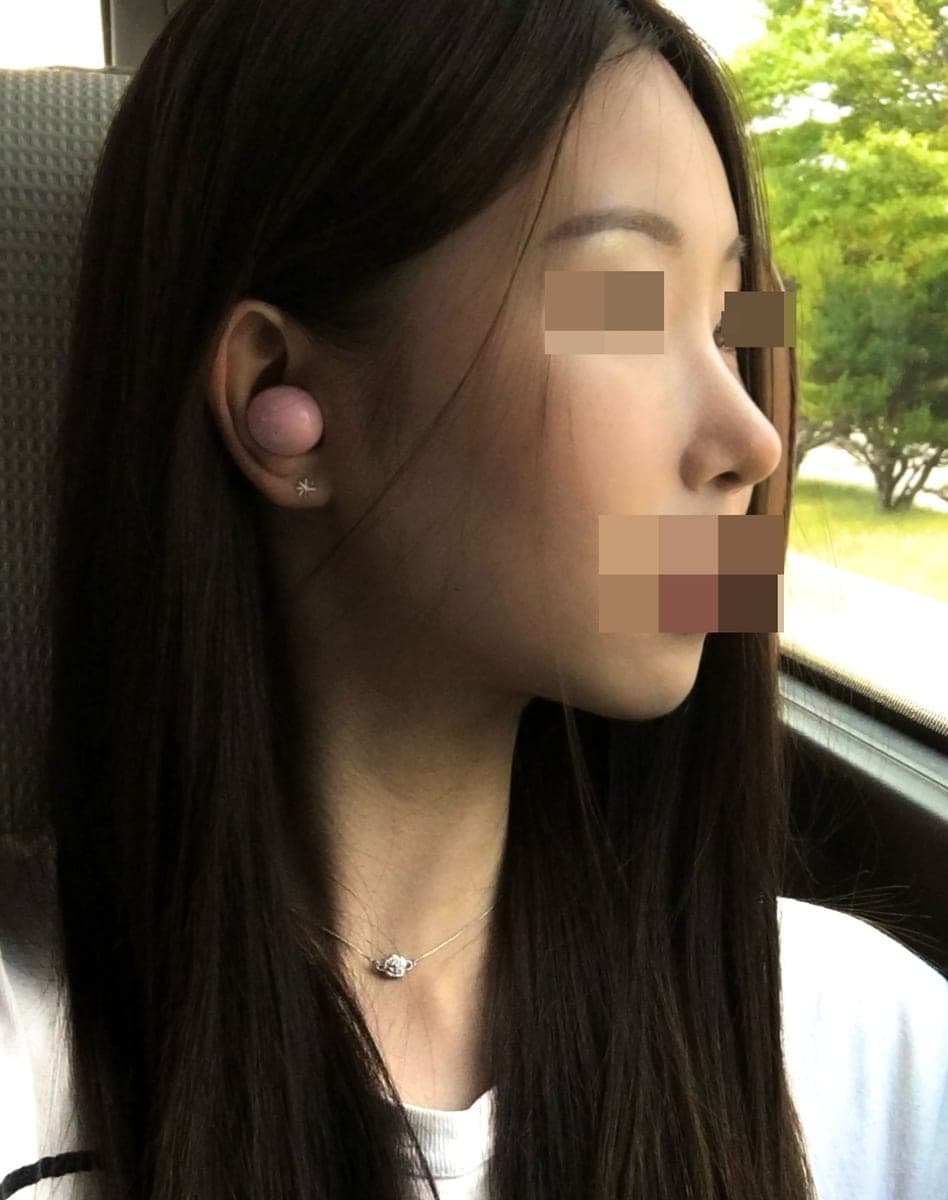 Tip only, with own cartilage