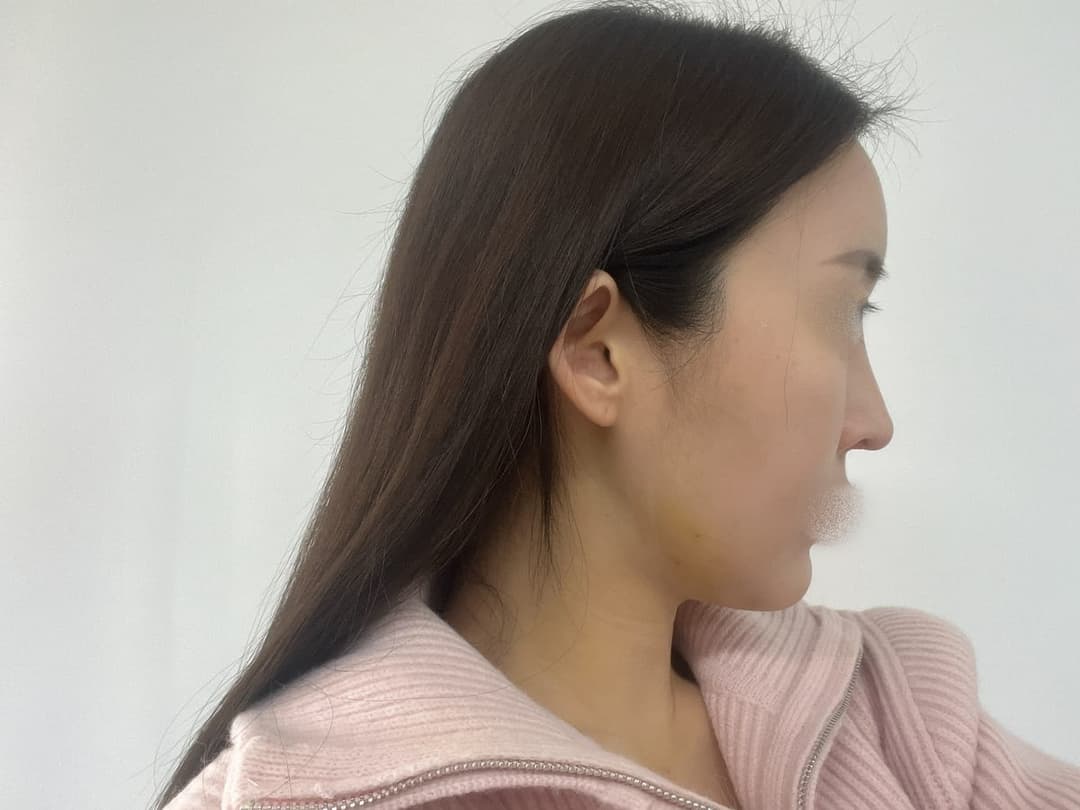 Implant removed, rebuilt with own cartilage