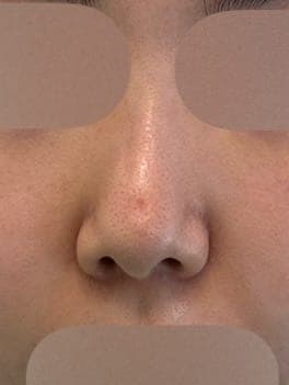 Revision rhinoplasty