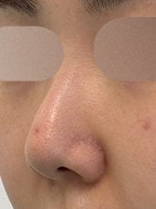 Revision rhinoplasty