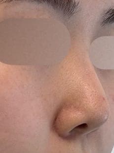 Revision rhinoplasty