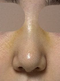 Revision rhinoplasty