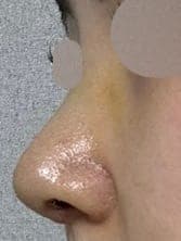 Revision rhinoplasty