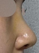 Revision rhinoplasty