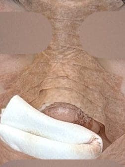 Revision rhinoplasty