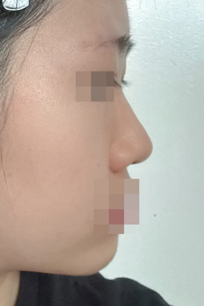 A bulbous nose correction case