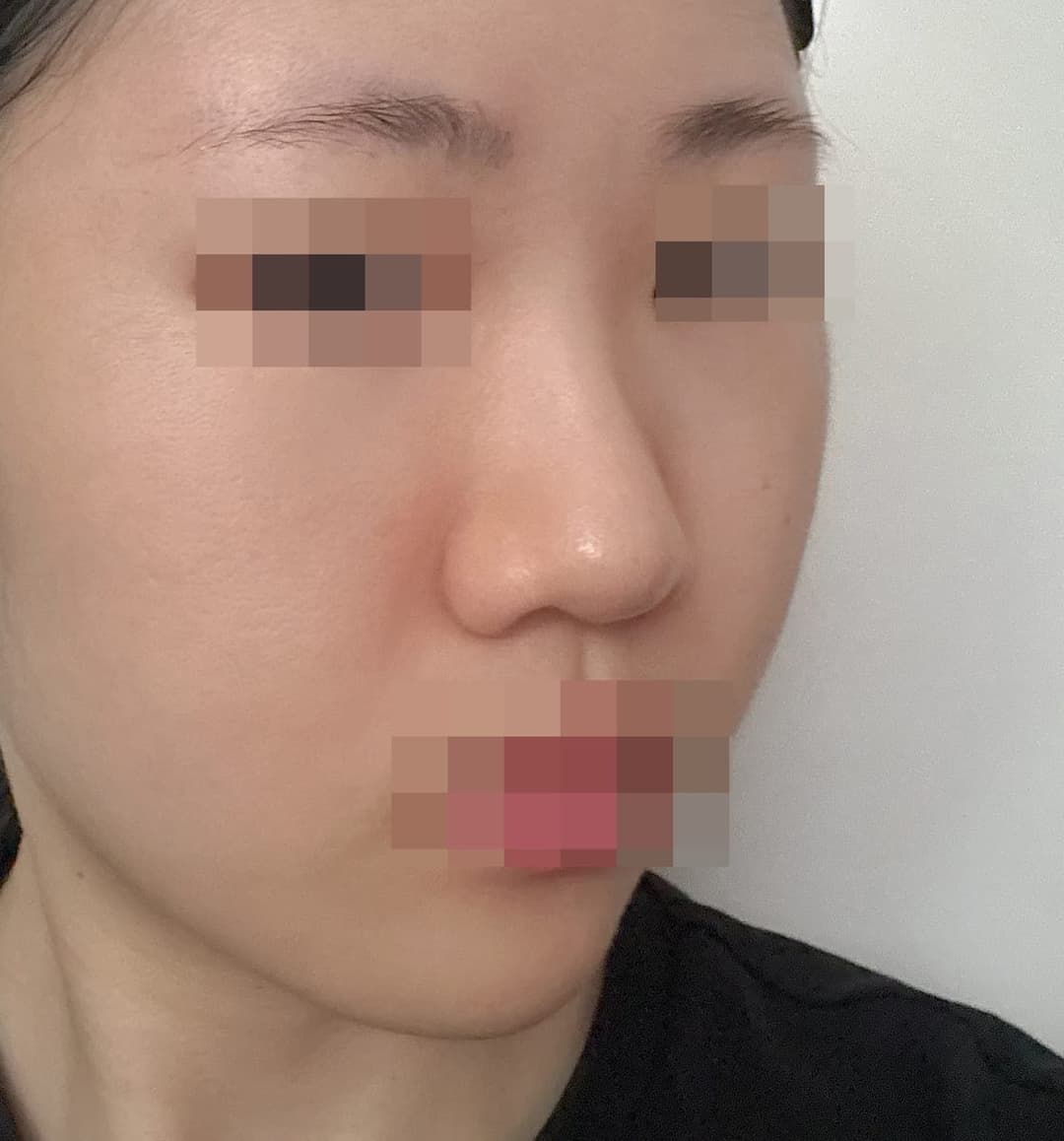A bulbous nose correction case