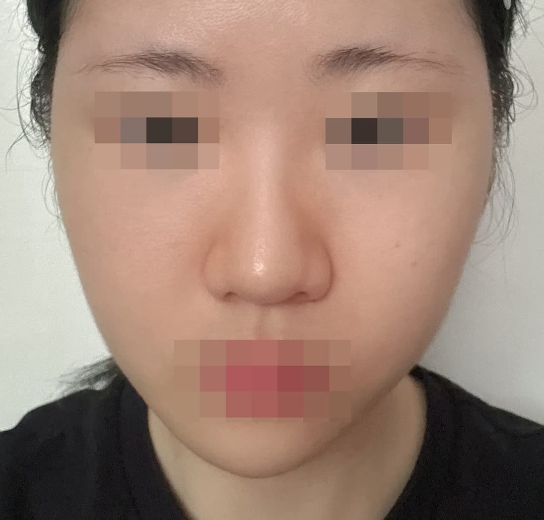 A bulbous nose correction case