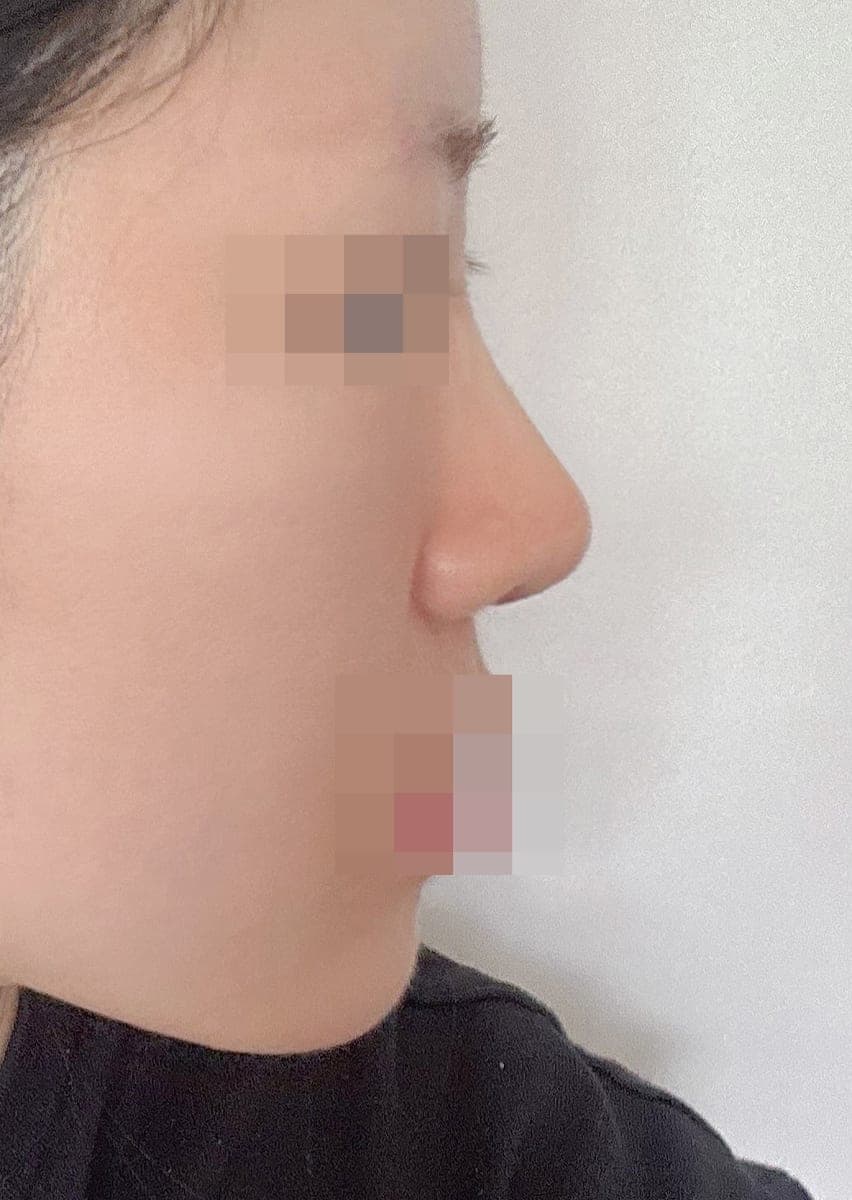 A bulbous nose correction case