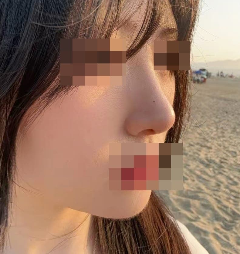 A bulbous nose correction case