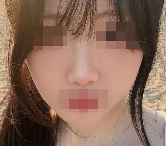 A bulbous nose correction case