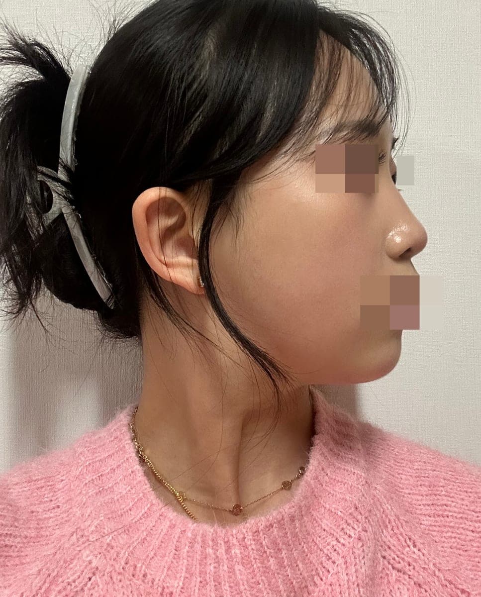 Refining the tip line with own cartilage