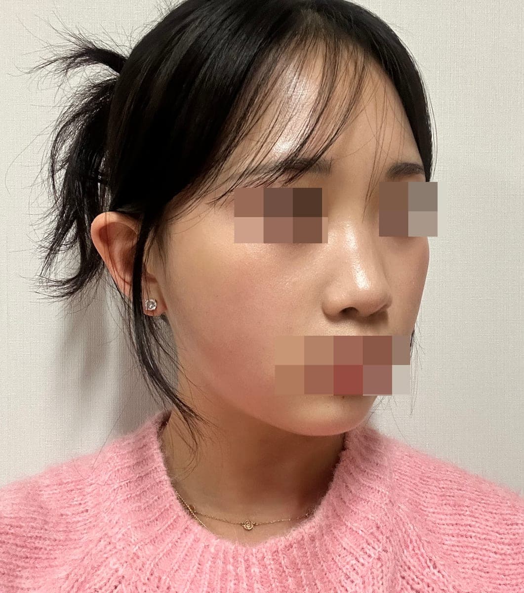 Refining the tip line with own cartilage