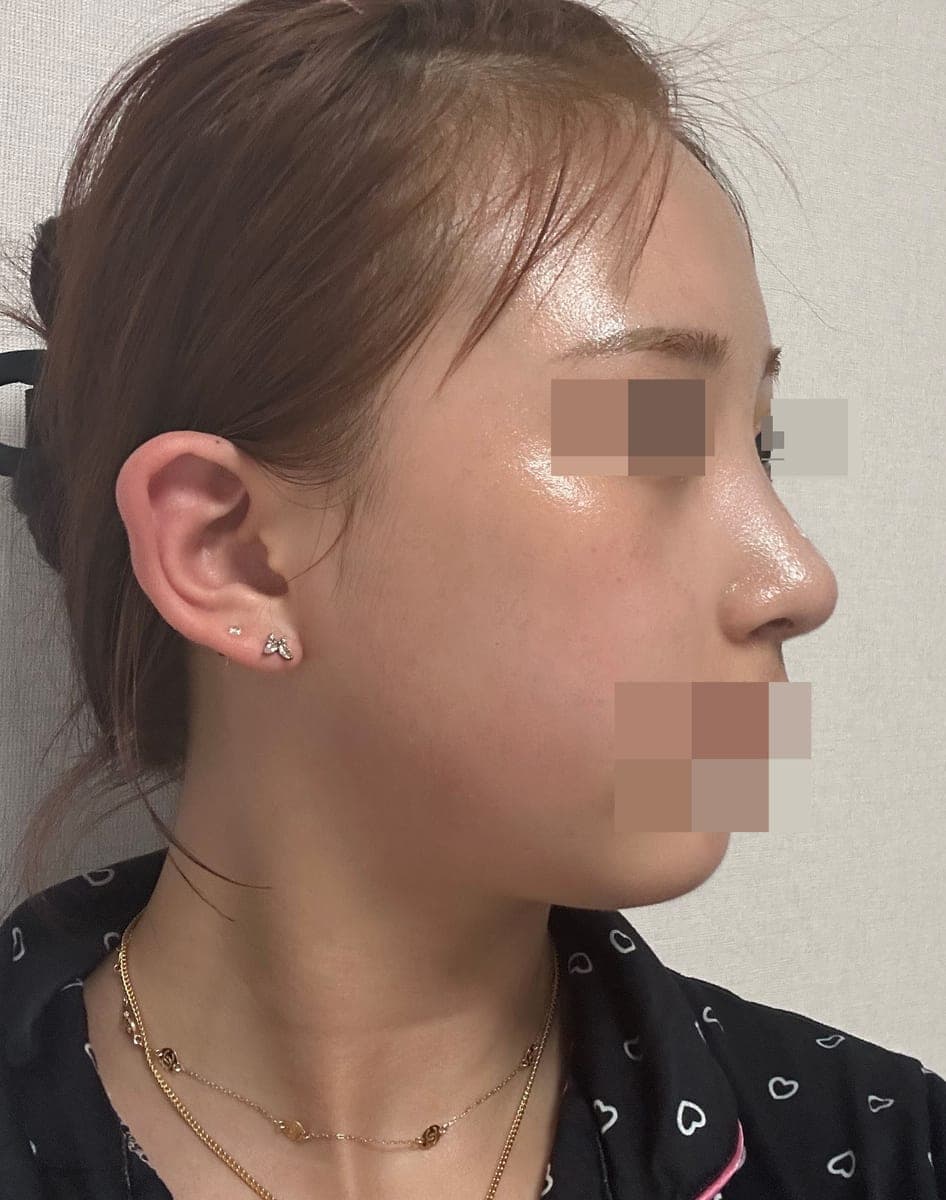 Refining the tip line with own cartilage