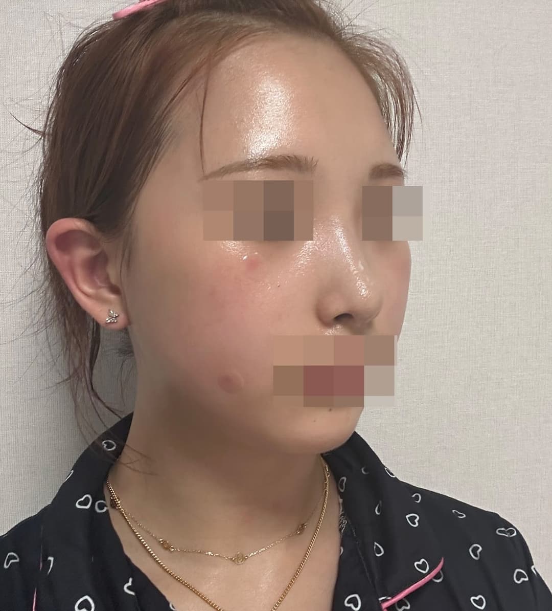 Refining the tip line with own cartilage