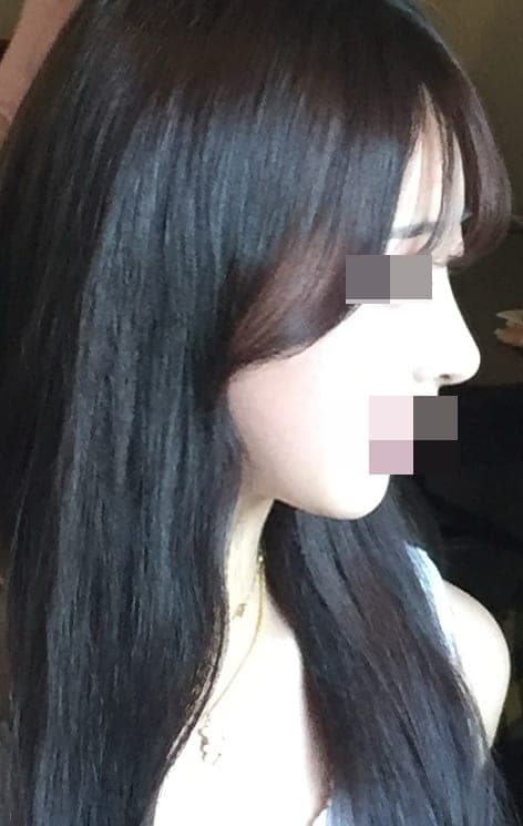 Refining the tip line with own cartilage