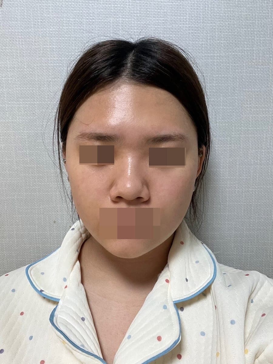 Hump reduction, tip with own cartilage