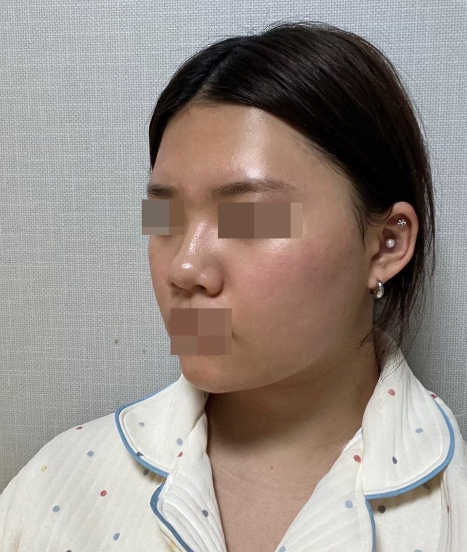 Hump reduction, tip with own cartilage
