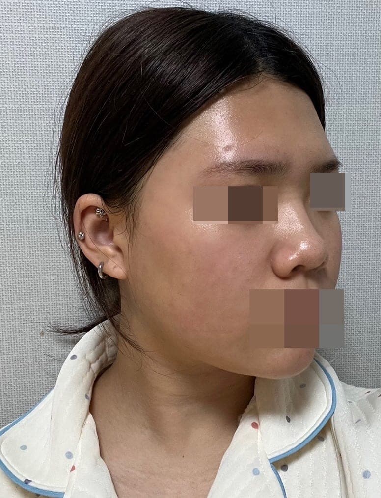Hump reduction, tip with own cartilage