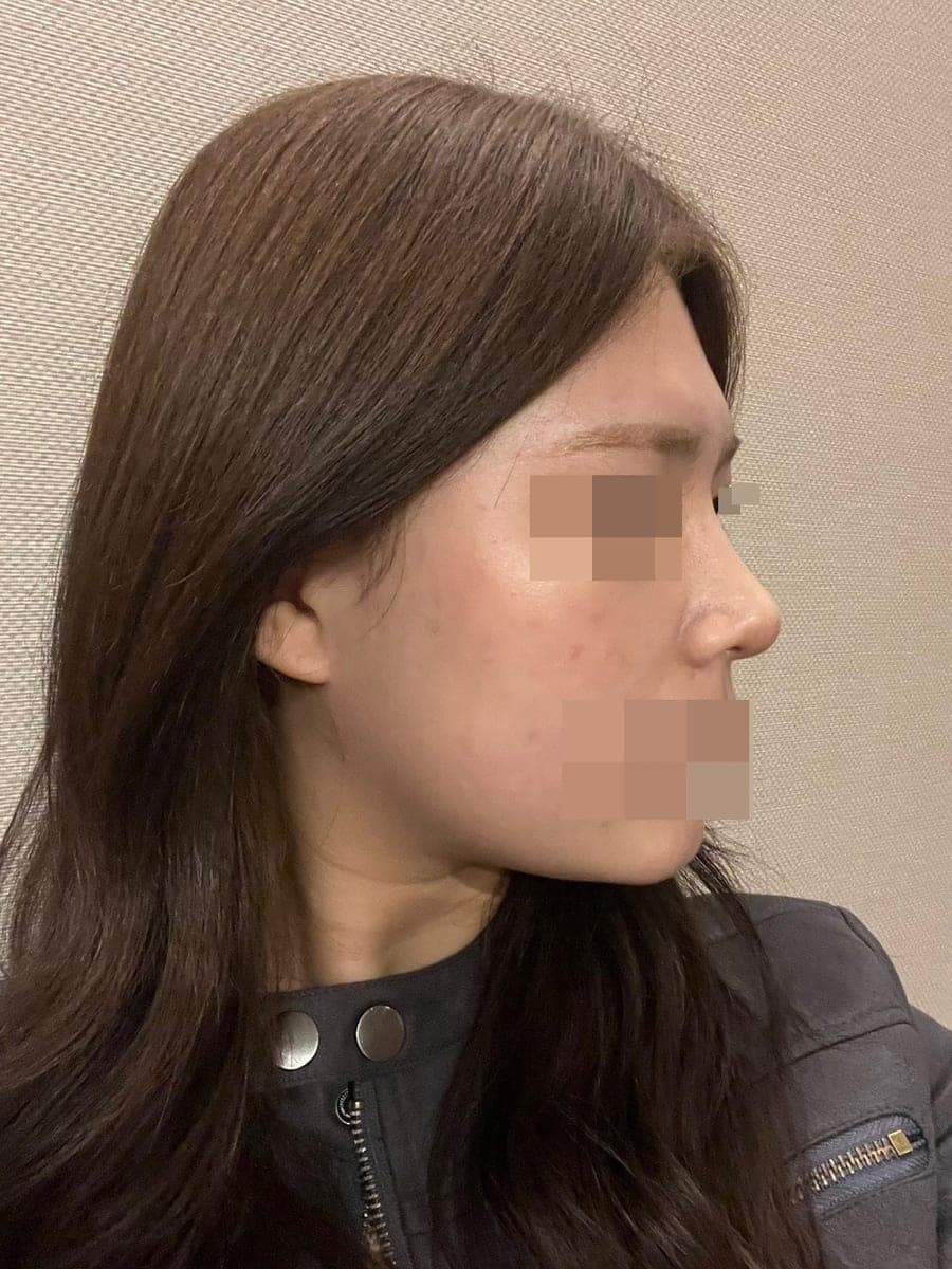 Hump reduction, tip with own cartilage