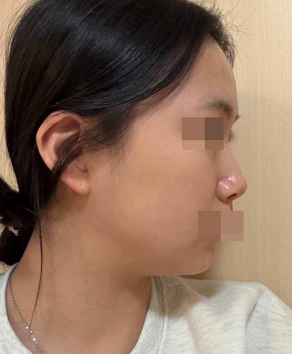 Tip only, with own cartilage