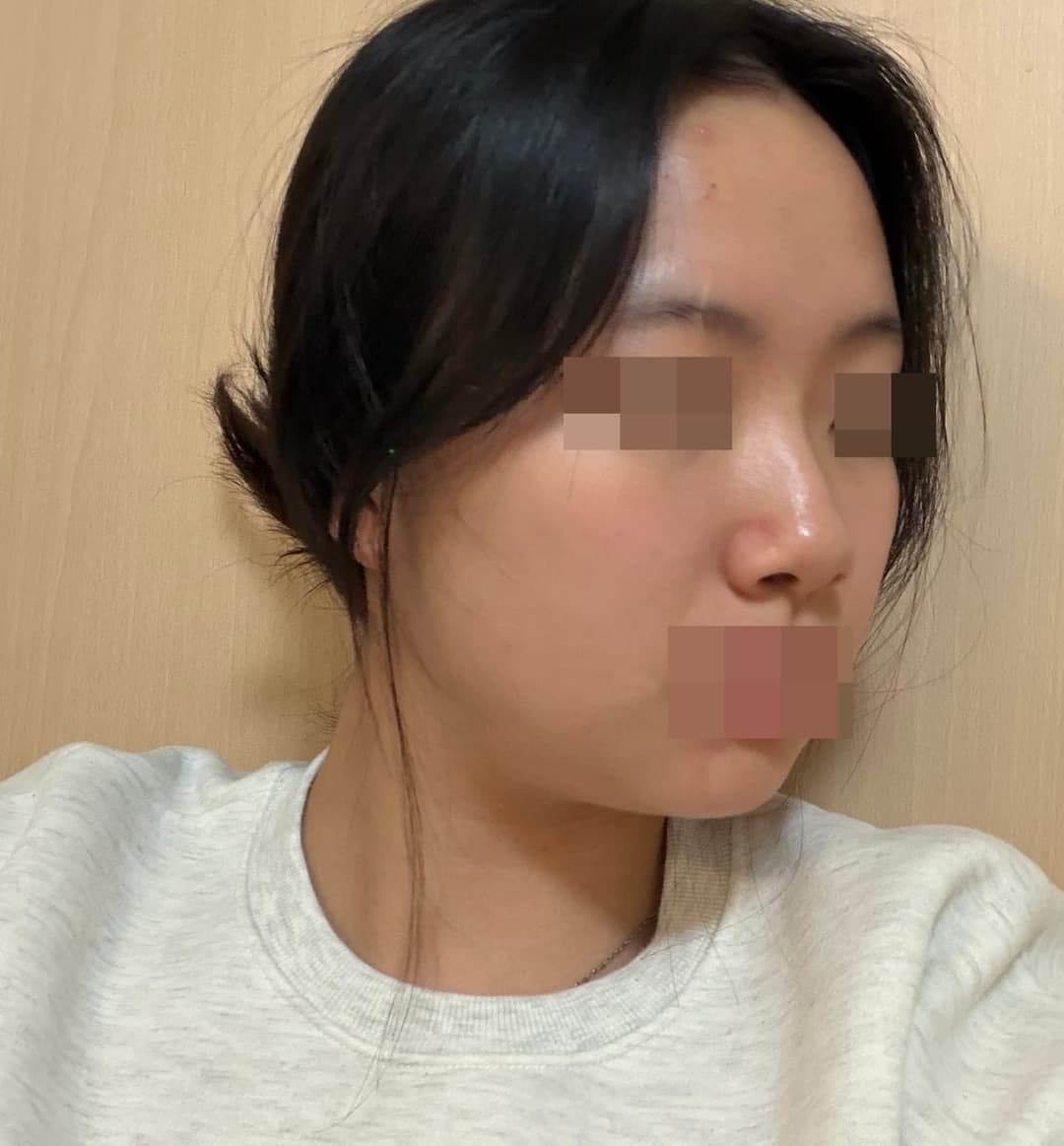 Tip only, with own cartilage