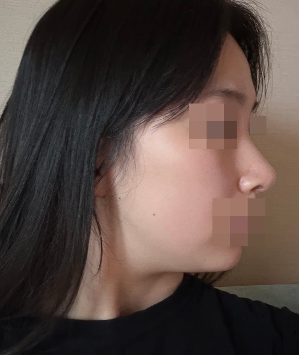 Tip only, with own cartilage