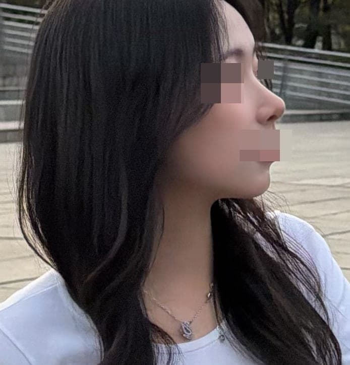 Tip only, with own cartilage
