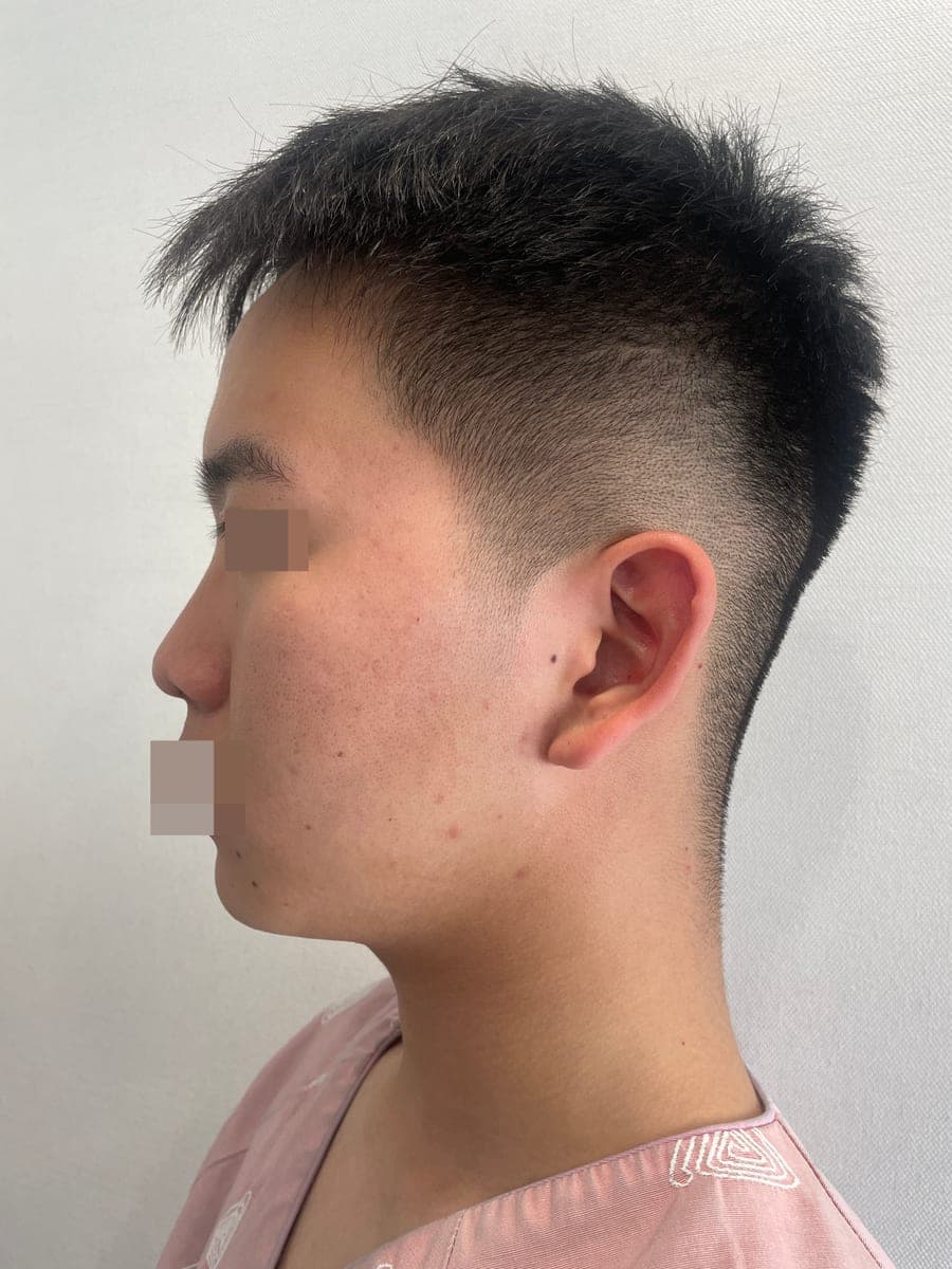 Bulbous tip and nose tip refined together