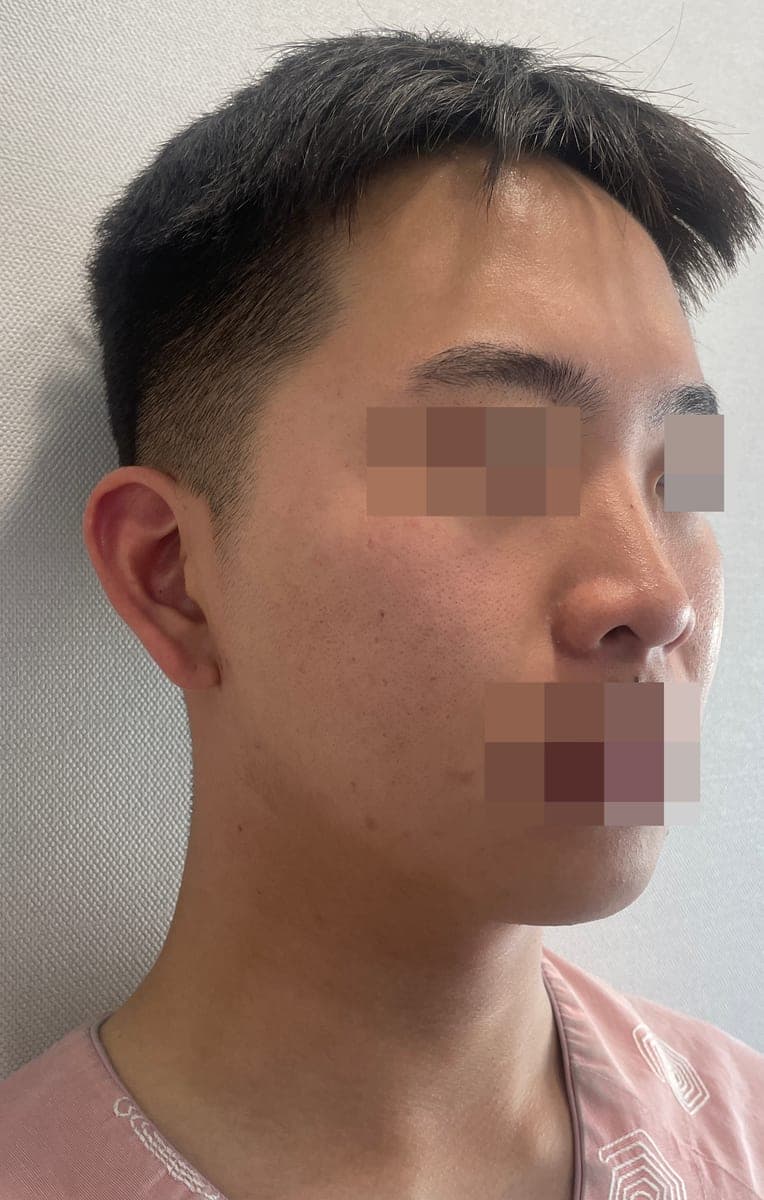 Bulbous tip and nose tip refined together