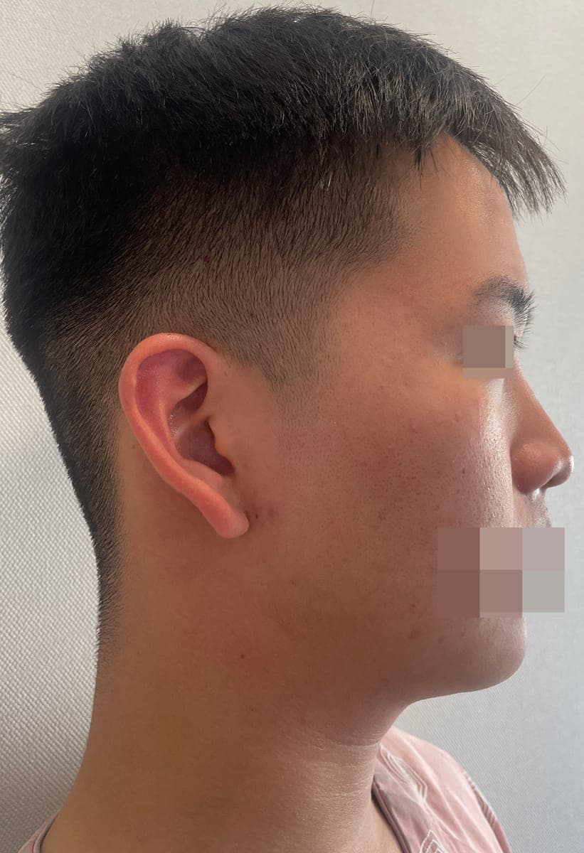 Bulbous tip and nose tip refined together