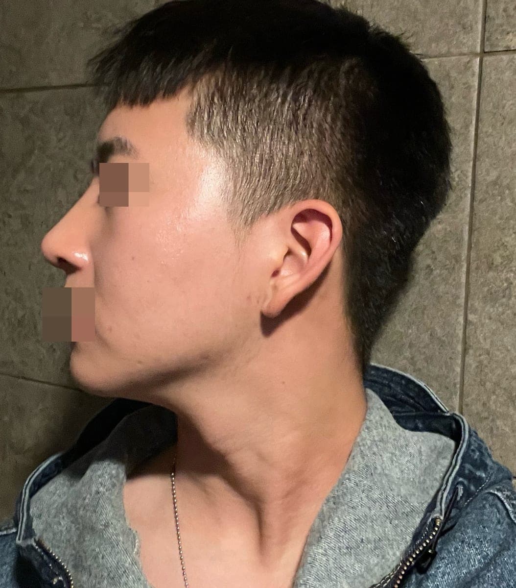 Bulbous tip and nose tip refined together