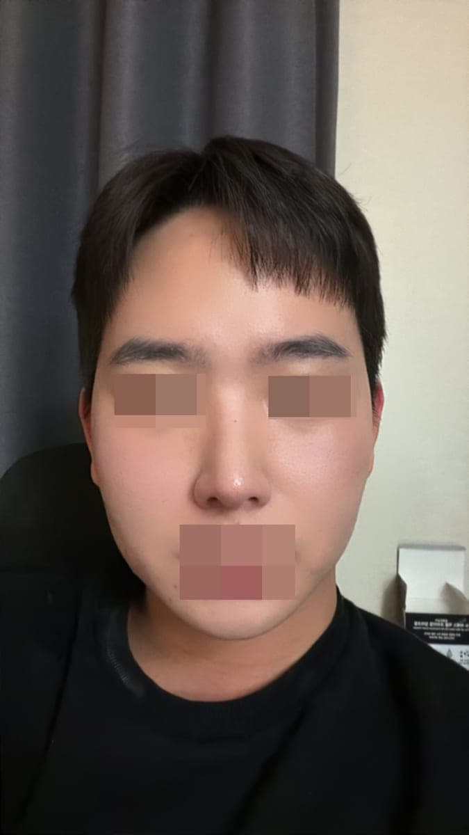 Bulbous tip and nose tip refined together