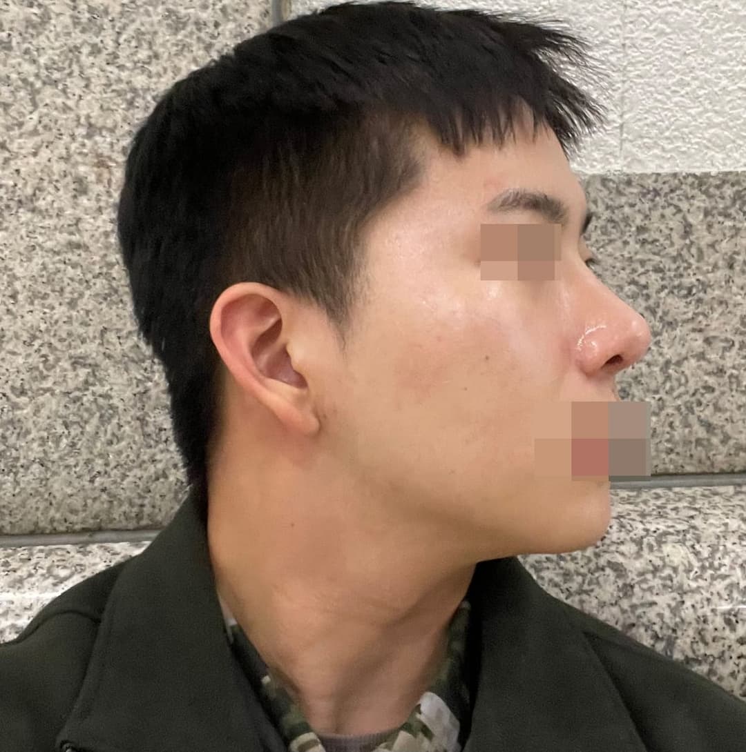 Bulbous tip and nose tip refined together
