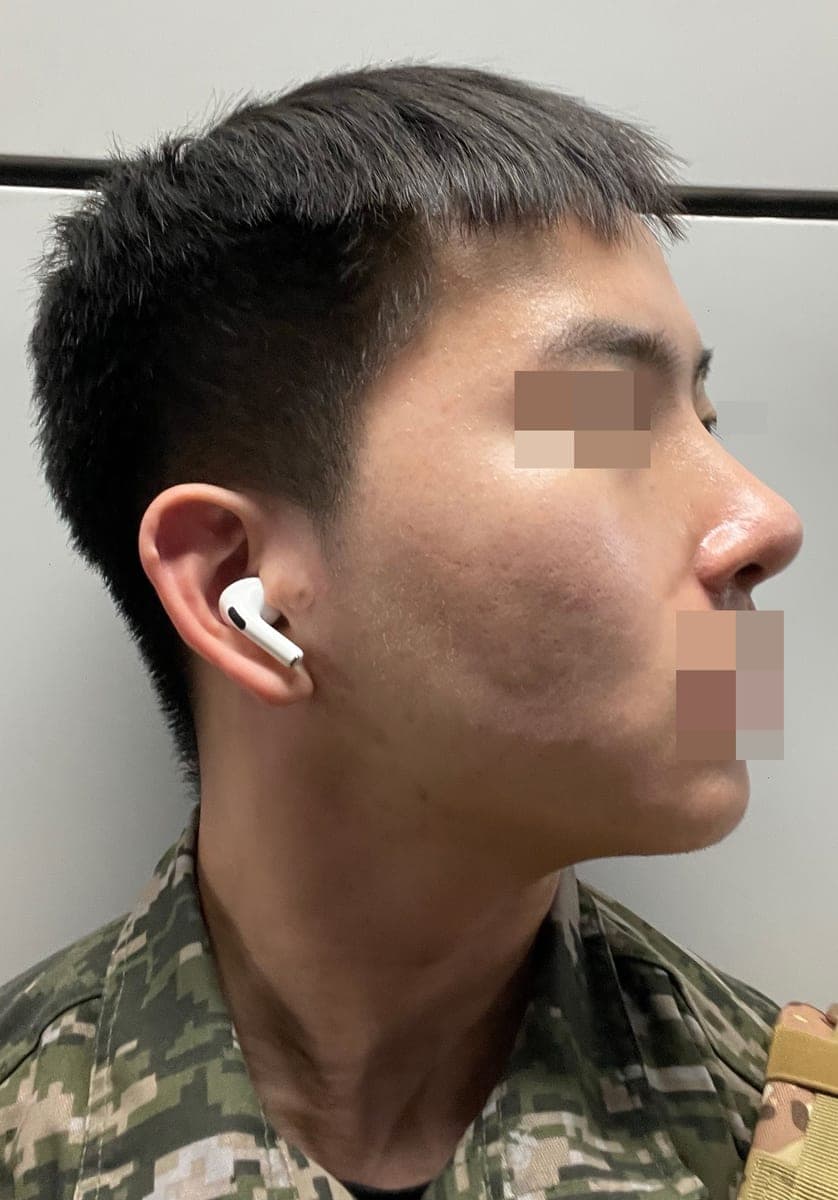 Bulbous tip and nose tip refined together