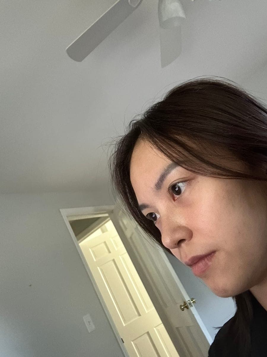 Bridge raised with own cartilage