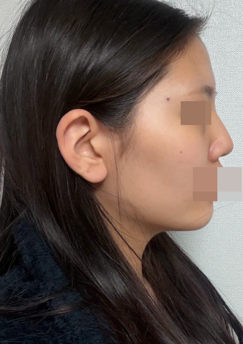 Tip plasty with own cartilage