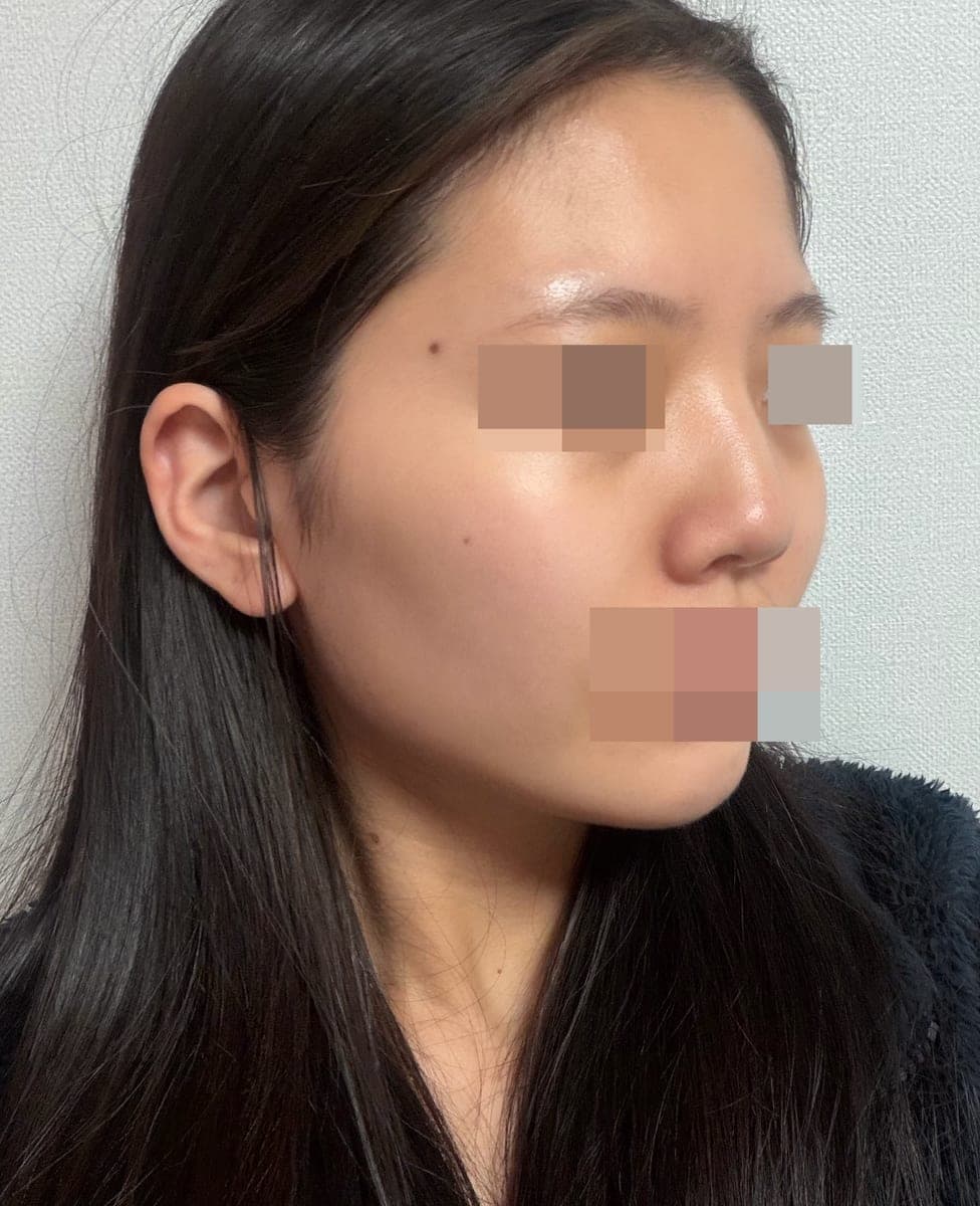 Tip plasty with own cartilage